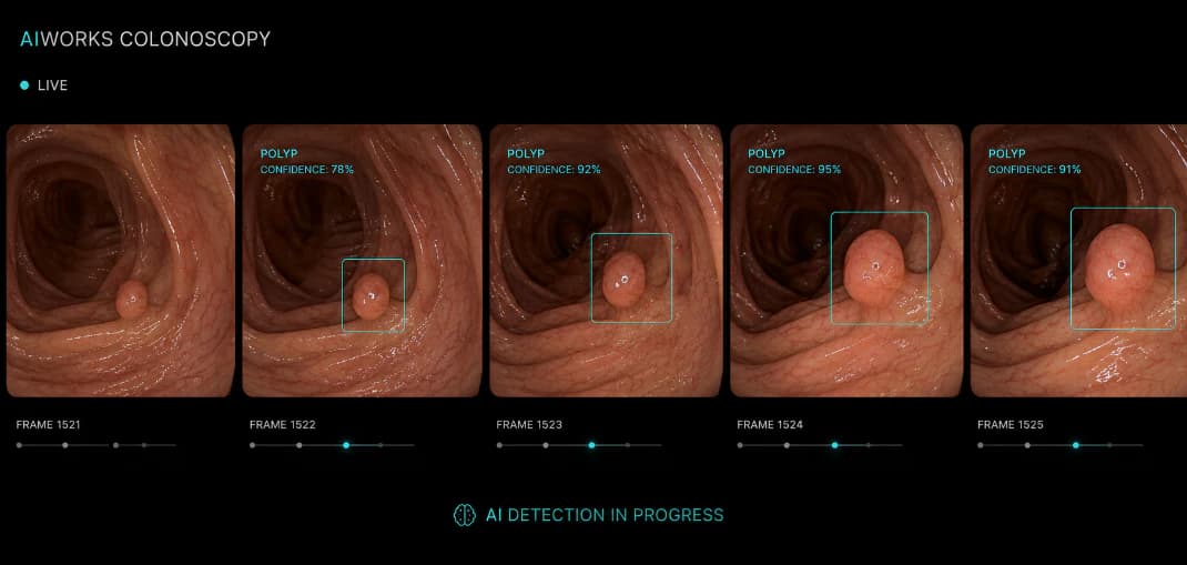 Frame sequence with real-time polyp detection