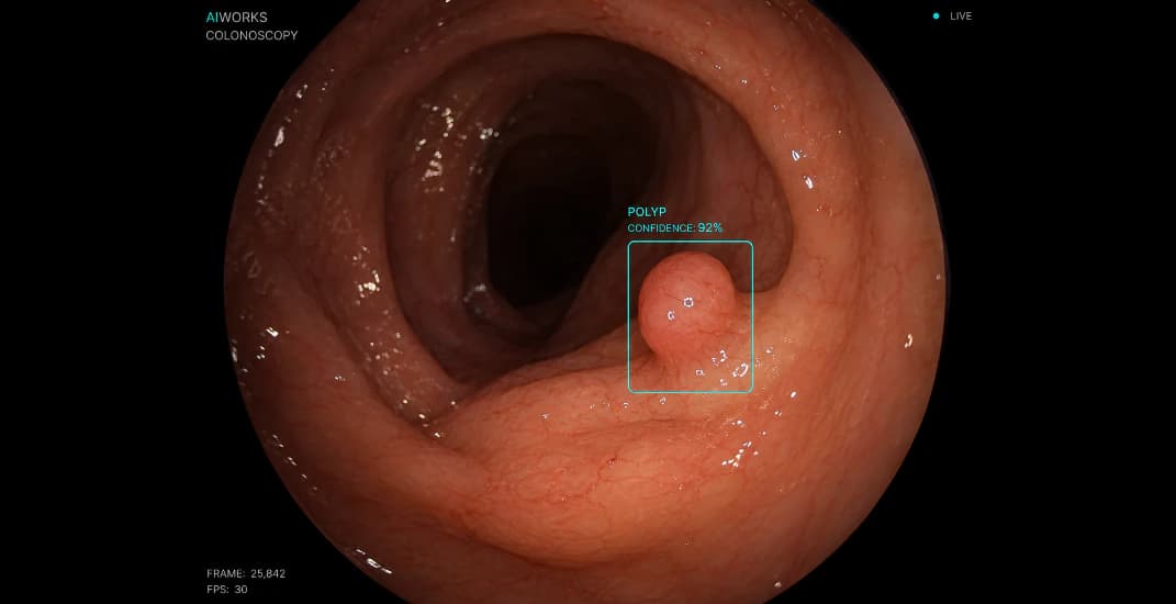 Polyp identified during an aiworks-assisted colonoscopy