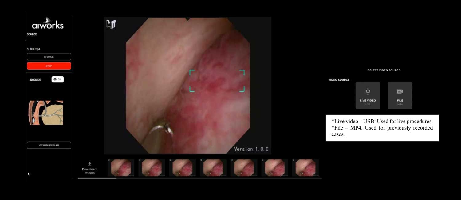 Aiworks colangioscopy